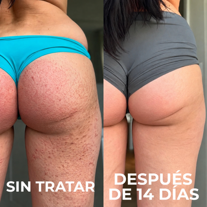 Crema alisadora triple ácido | Vuelve a lucir tu piel